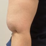Lipedema