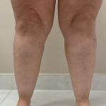 Lipedema2